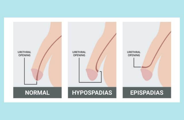 हाइपोस्पेडियास सर्जरी: कारण, उम्र, इलाज और सही समाधान